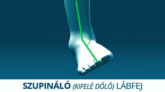 Szupináló (kifelé dőlő) lábfej